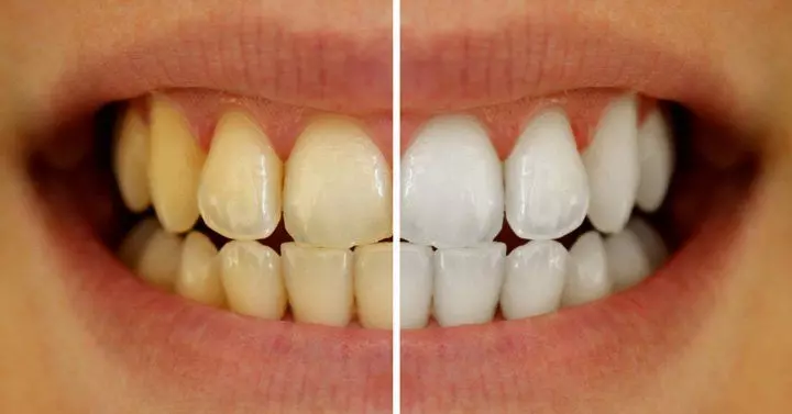 Home Remedies For Yellow Teeth