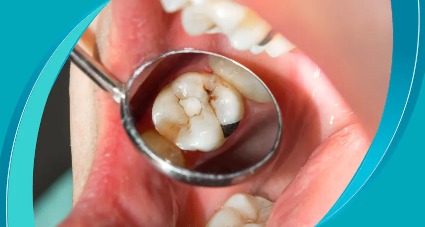 How To Deal With Rotten Teeth
