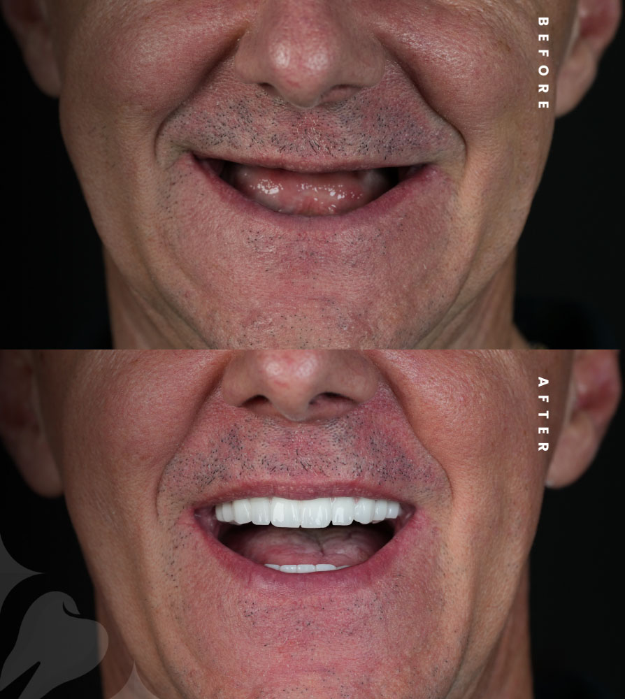 Diş implantları