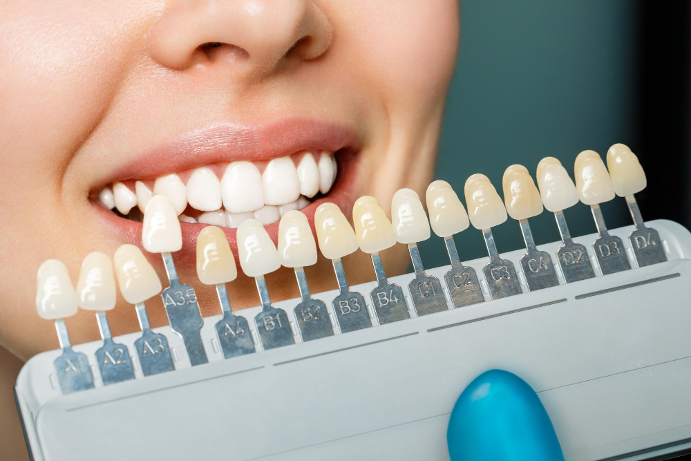 Price Comparison Of Dental Veneers