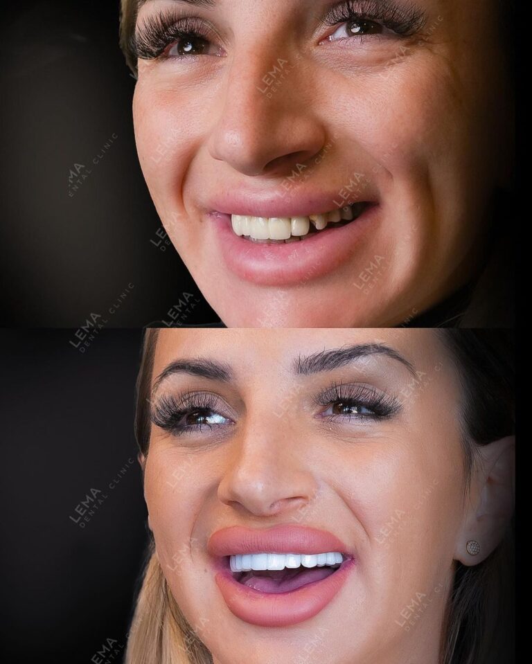 diş kaplamaları