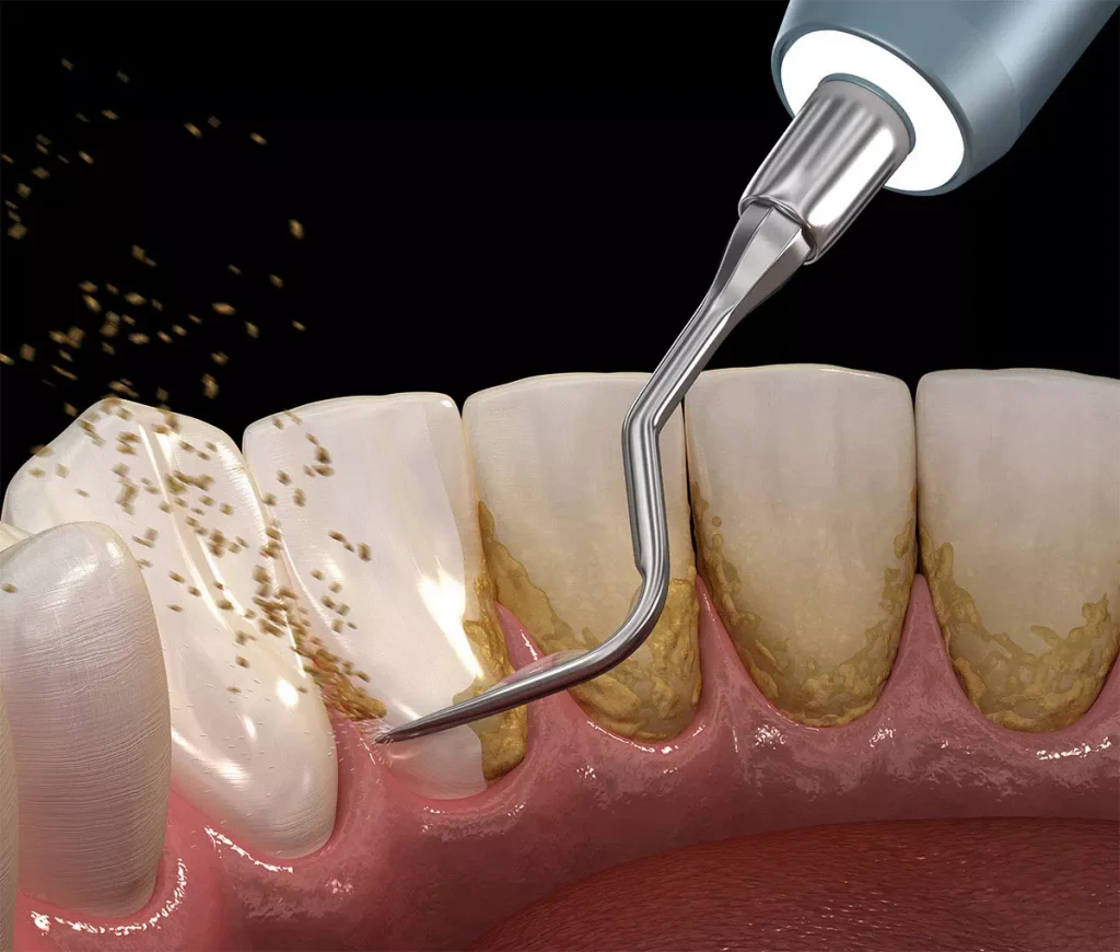 Yellow Teeth Remedies: Home Vs Professional