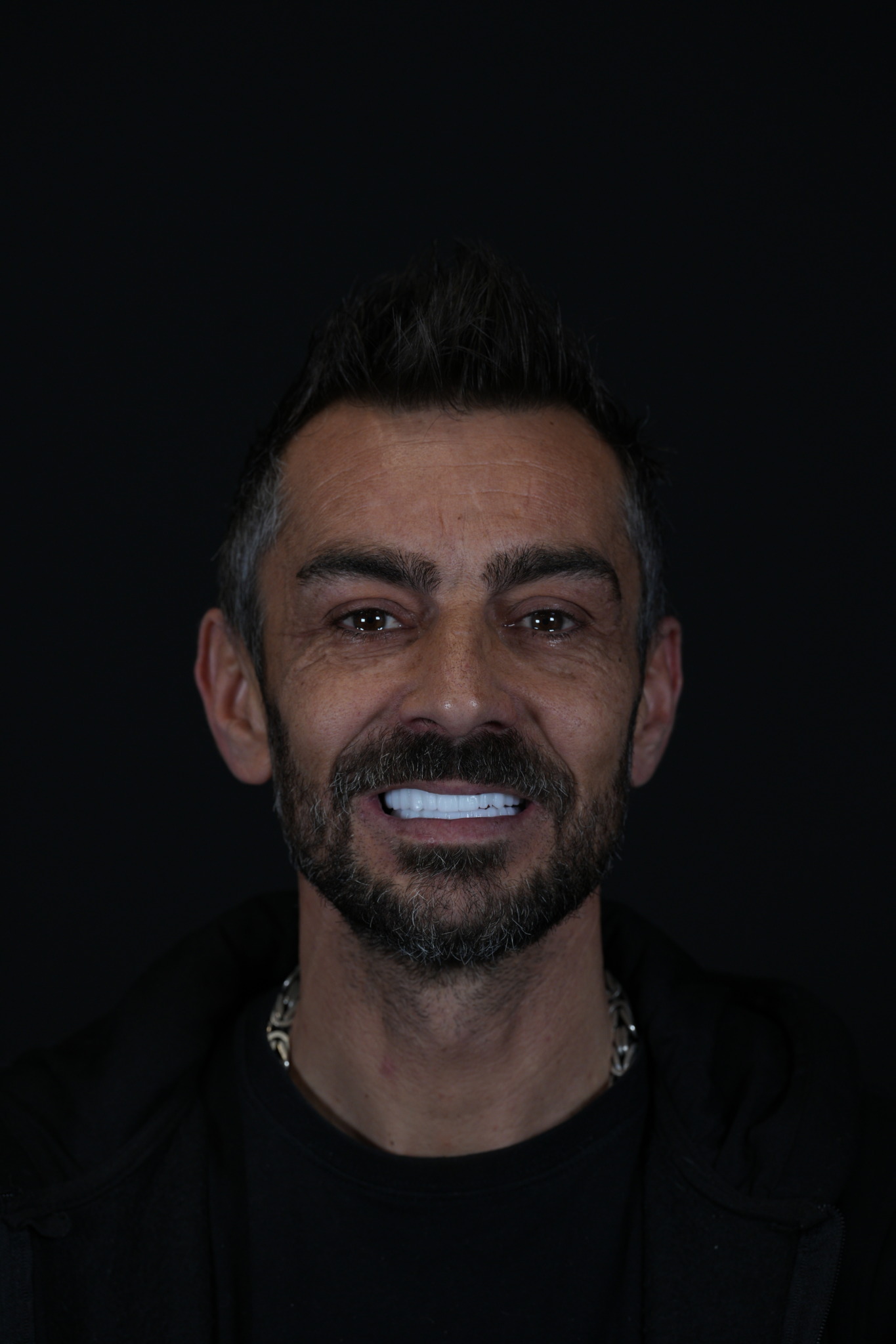 Emax Dental Veneers Overview Lema Dental Clinic