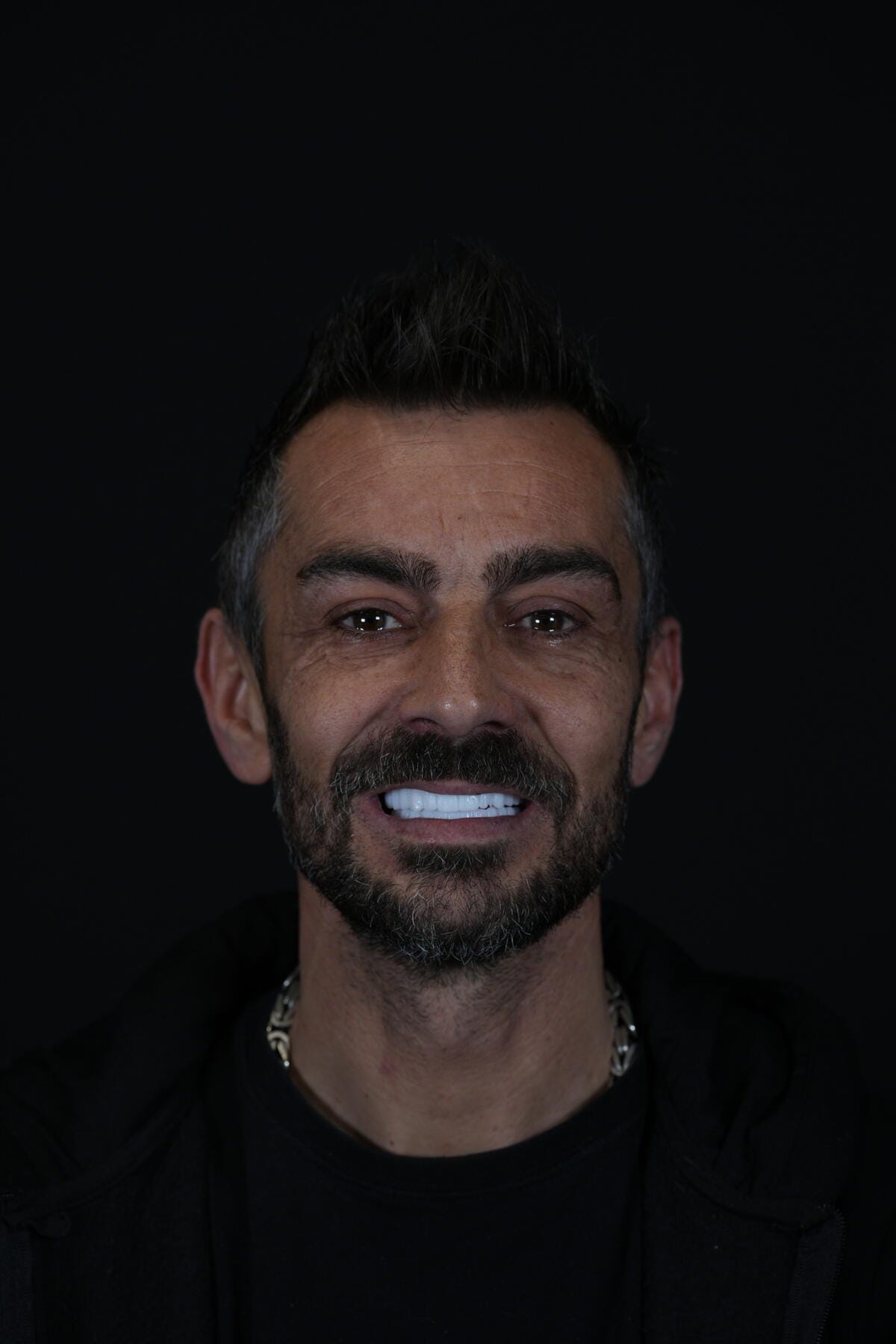 Emax Dental Veneers Overwiev 2024 Lema Dental Clinic