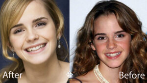 emma watson dents avant apres