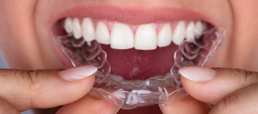 Best Night Guards For Tmj