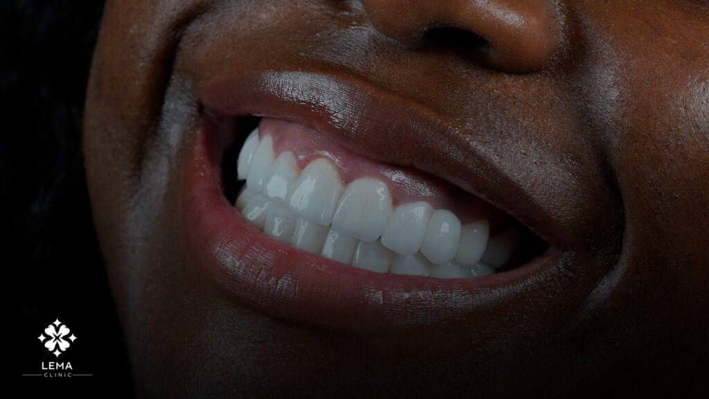 Guida alla cura del sorriso di Hollywood