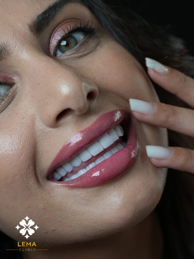 имали холивудска усмивка и фасети