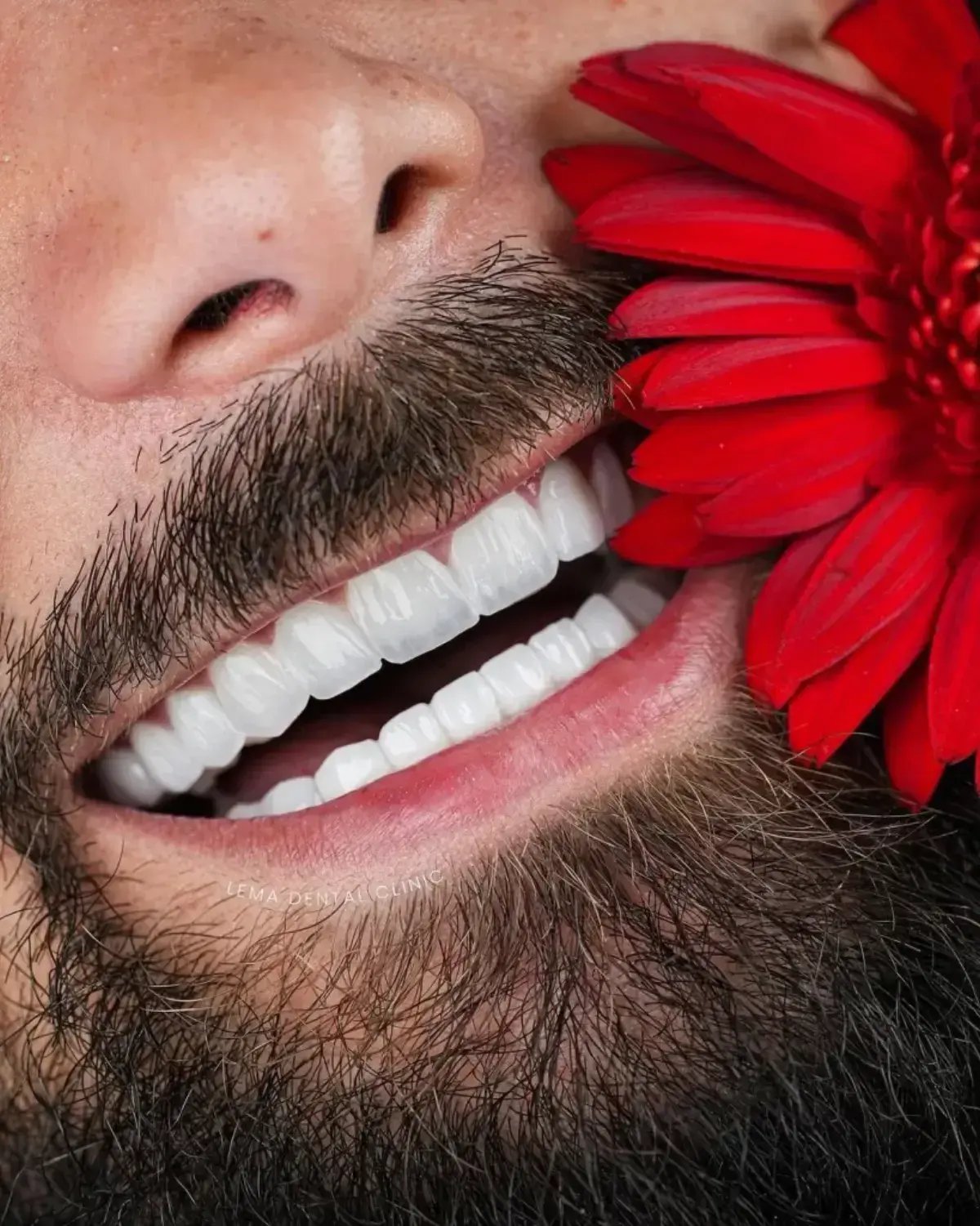 холивудска усмивка в Лема клиник