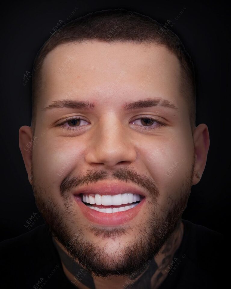 hollywood smile