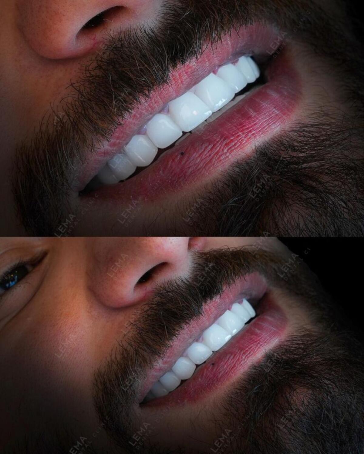 hollywood smile1