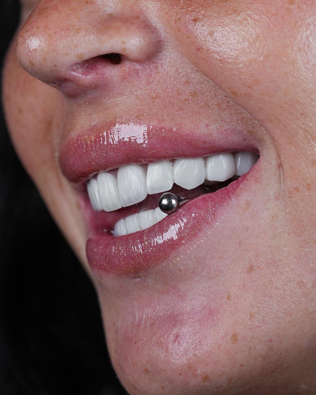 implants