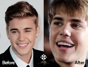 justin bieber зубы