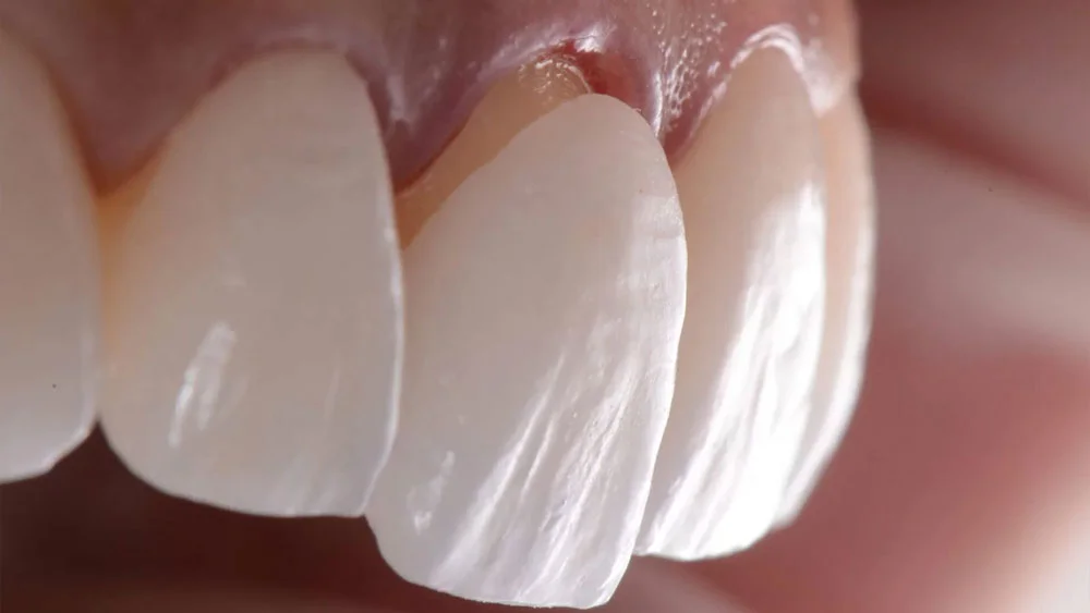 Porcelain Veneers: Price And Benefits