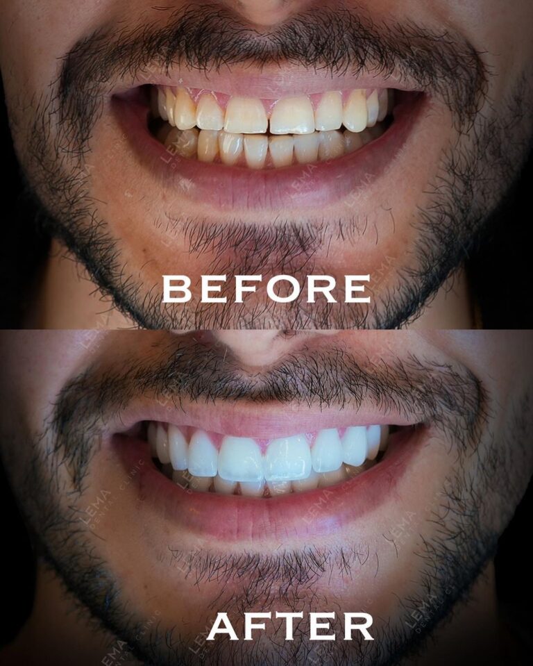 le traitment de blanchiment des dents