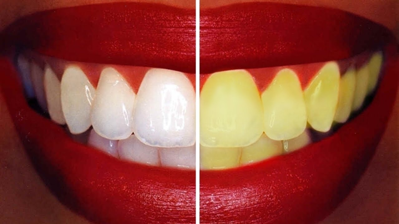 How To Get Rid Of Yellow Teeth Permanently