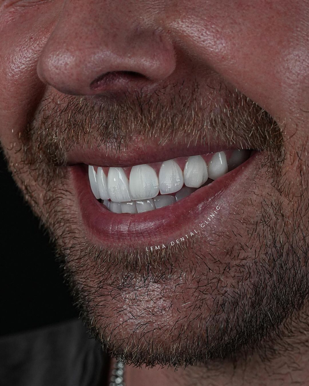 mieux blanchiments des dents
