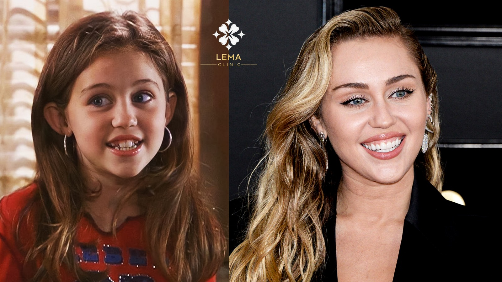 Evolución de la Sonrisa de Miley Cyrus - Lema Clínica Dental