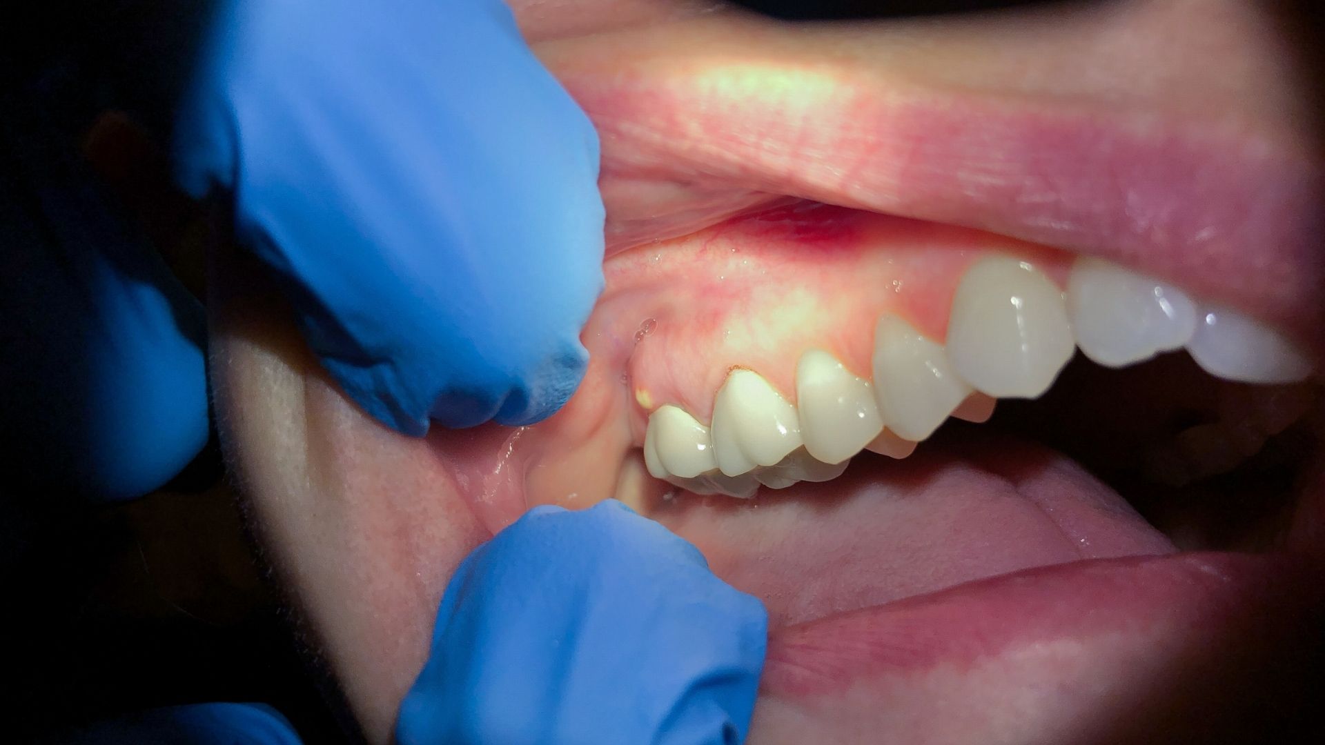 abces dentar