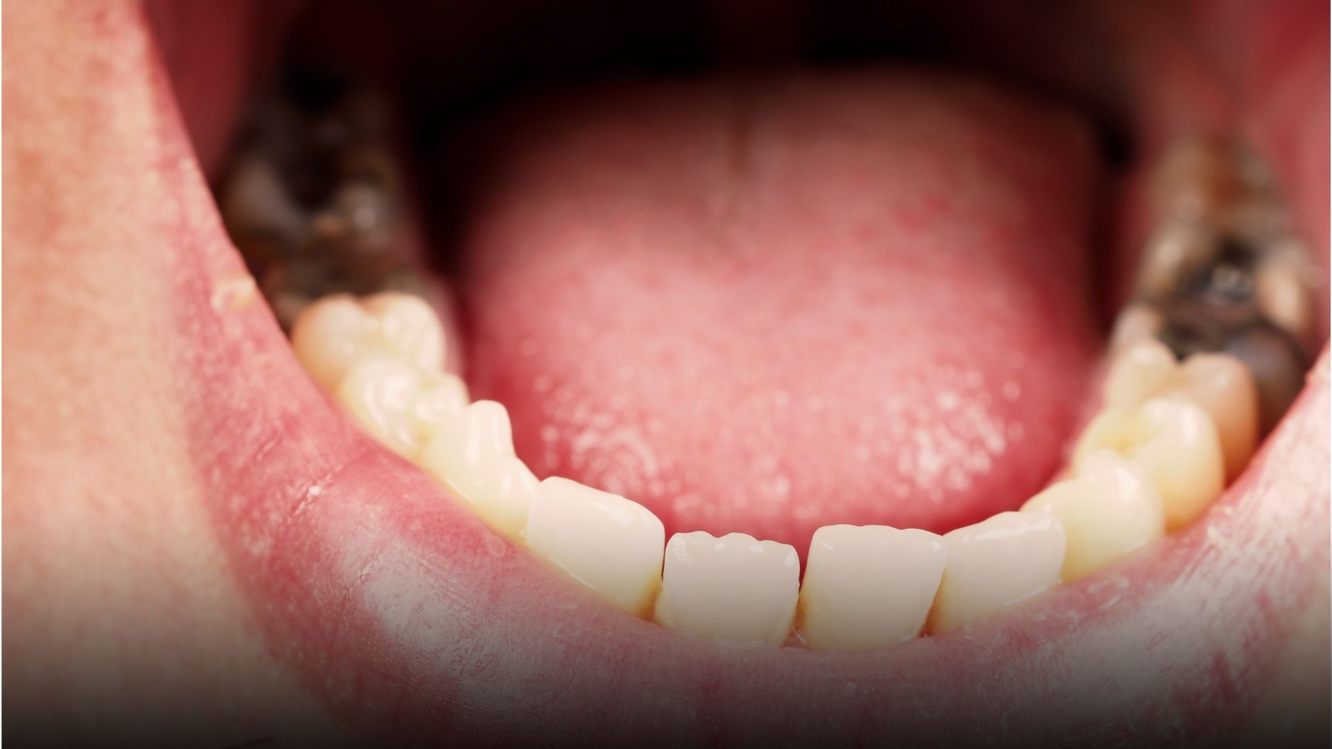 tratament carii dentare