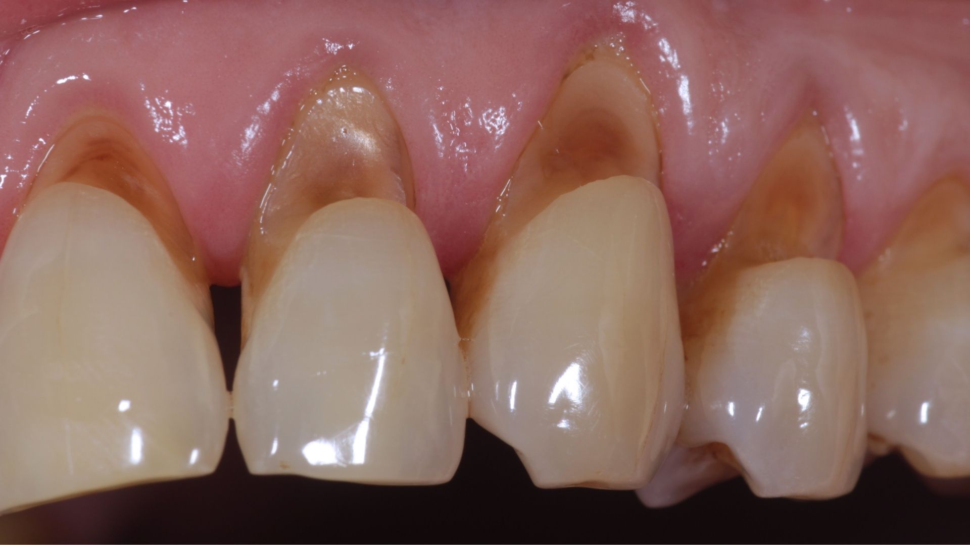 Tratamentul în abraziunea dentară