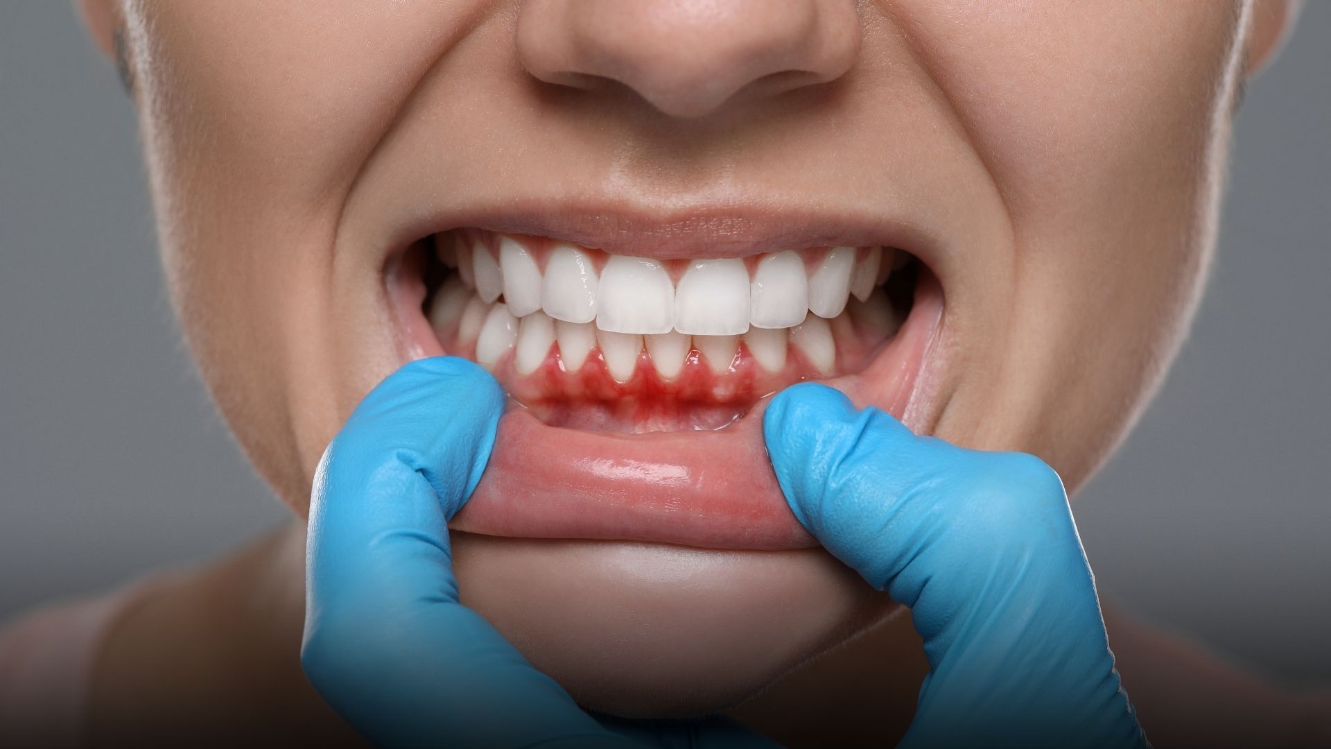 sangerari gingivale