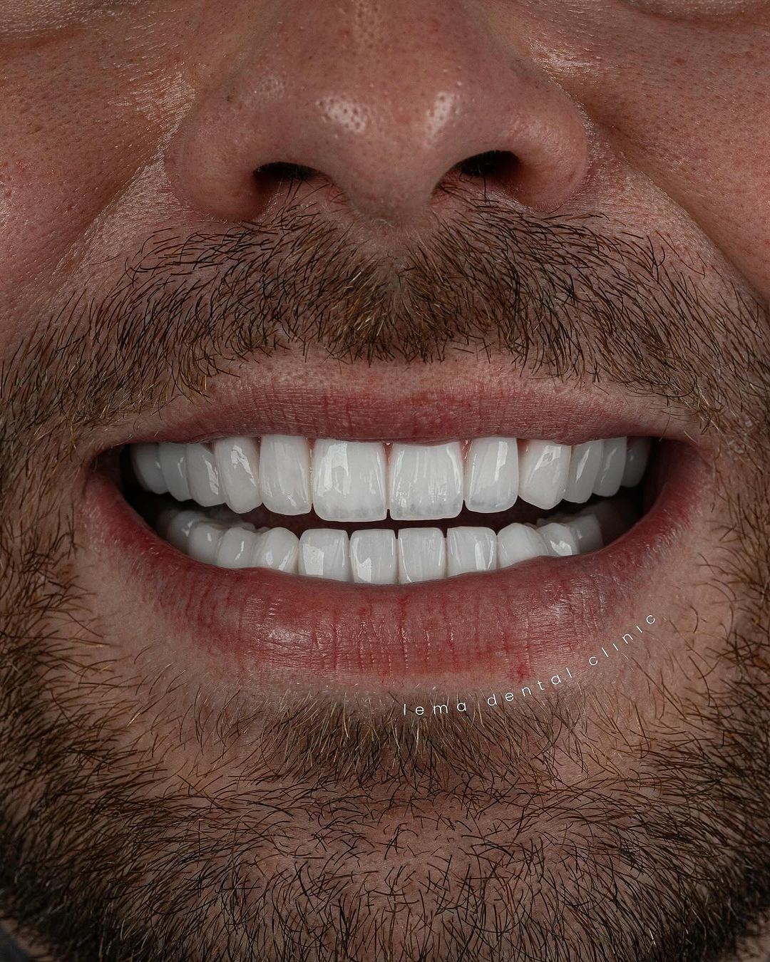 partial dentures