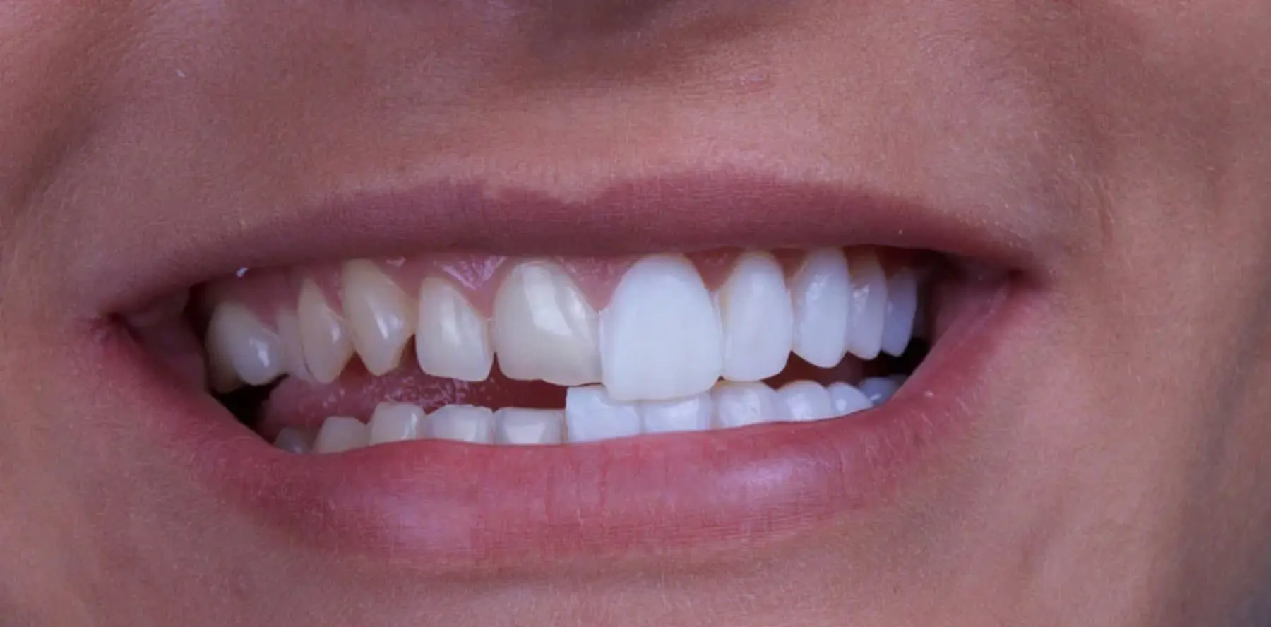 Porcelain Veneers: Price And Benefits