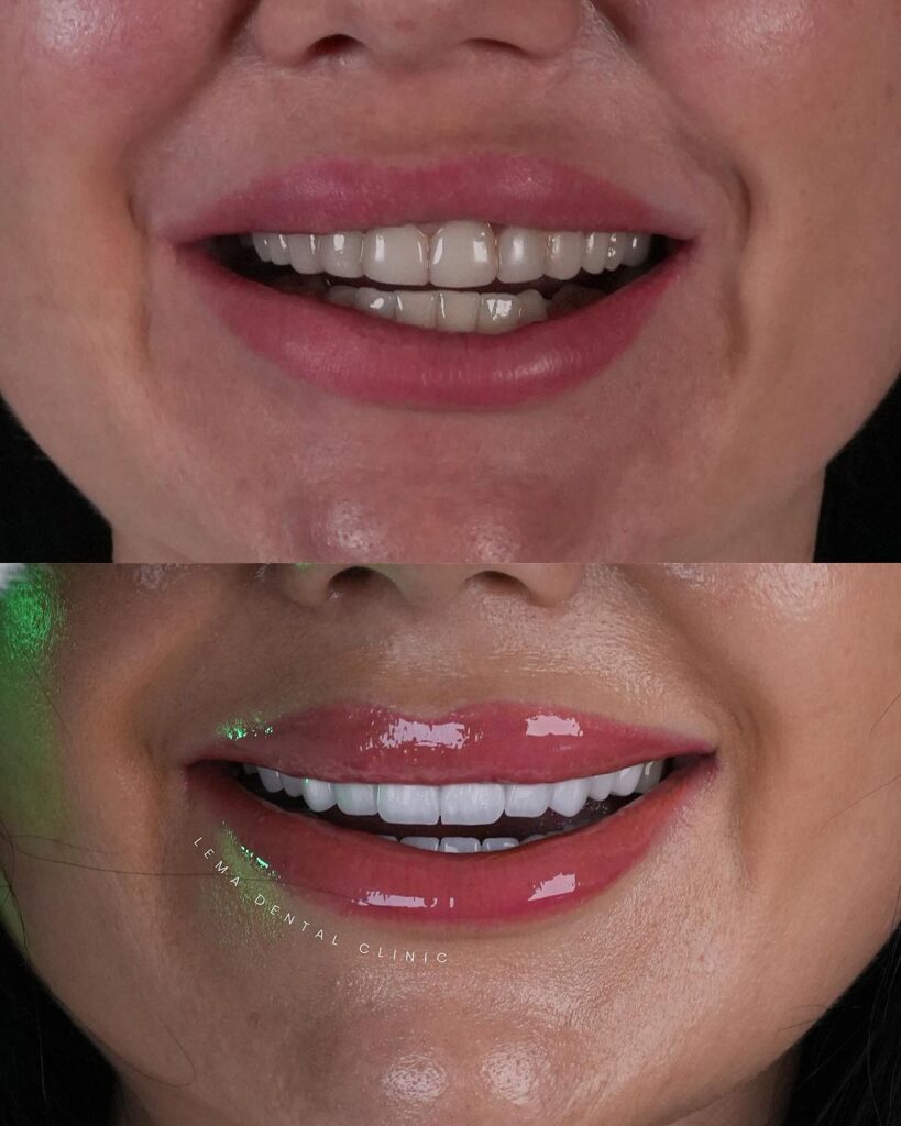 Was ist der Unterschied zwischen Lumineers und Veneers | Lema Dental Clinic, image size:819x1024