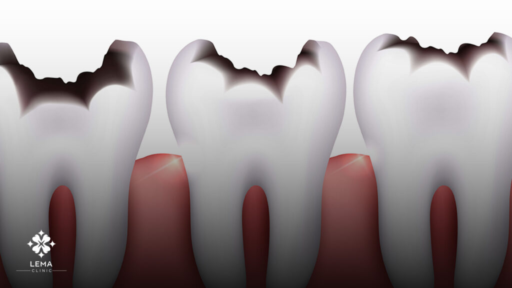 Dientes abscedados