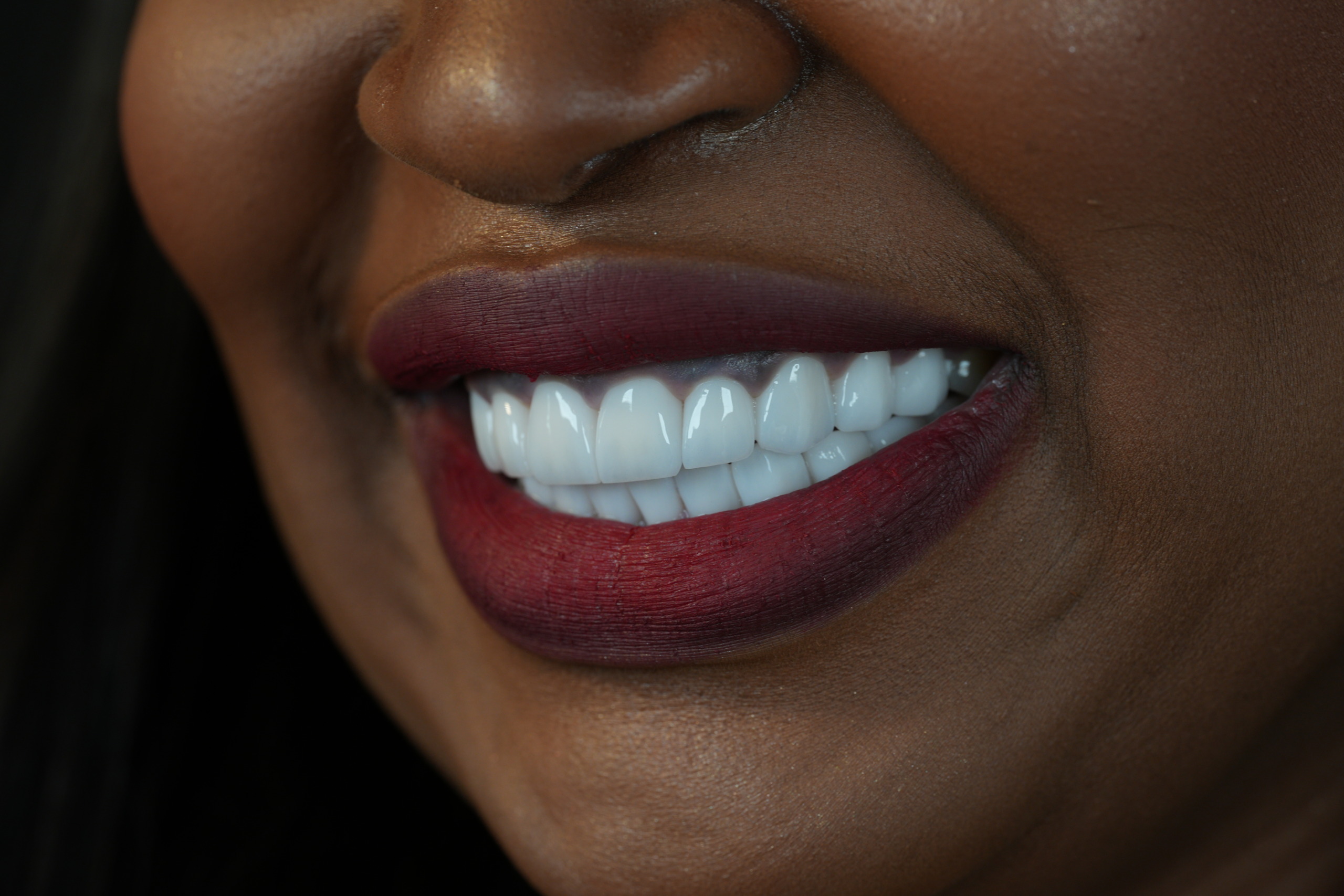 sinus lift pour implants maxillaires