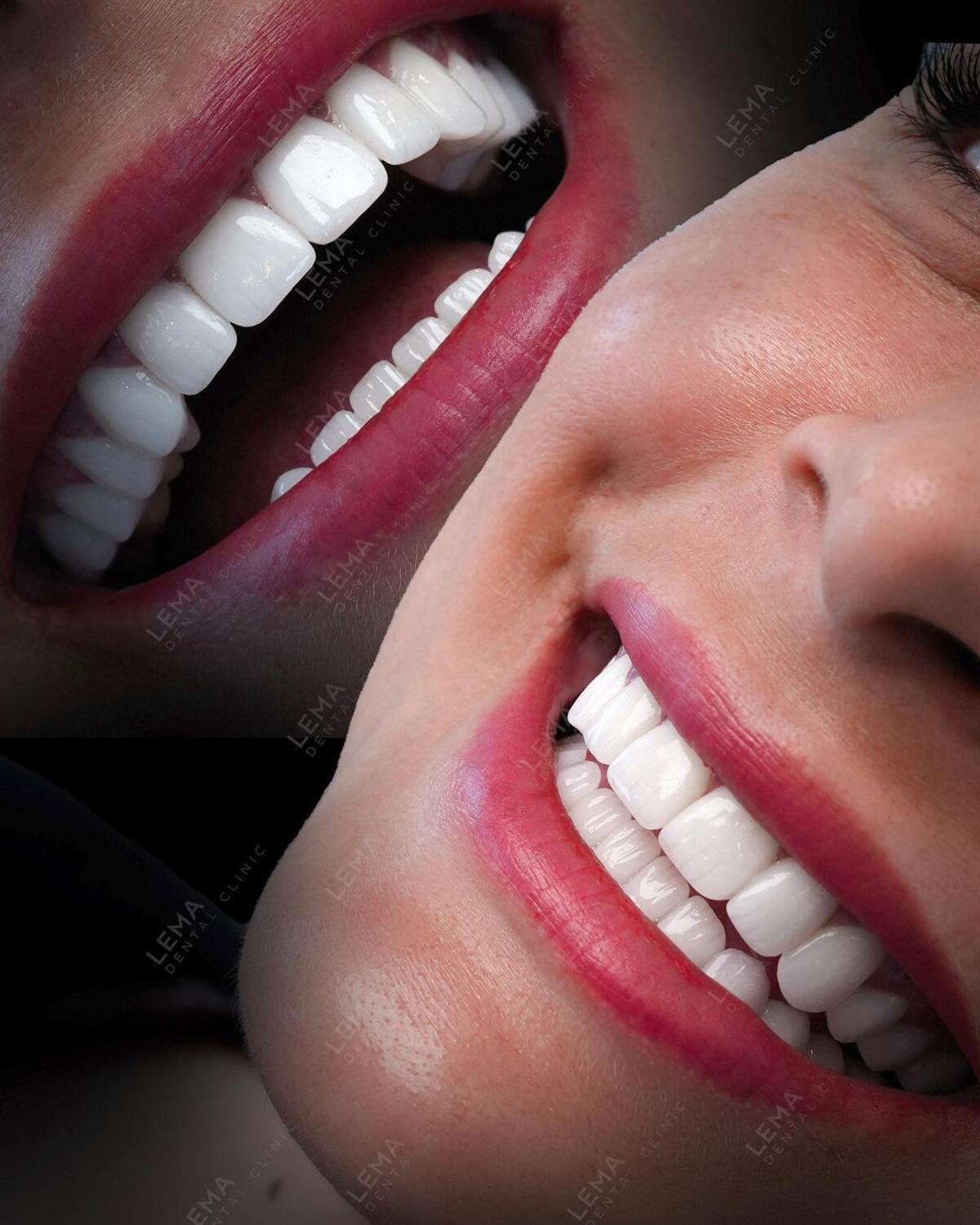 Is Teeth Whitening Treatment Harmful? 2024 Lema Clinic