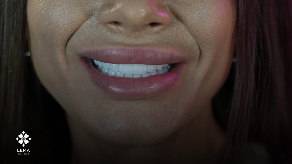 Why Is Gummy Smile Surgery Performed?