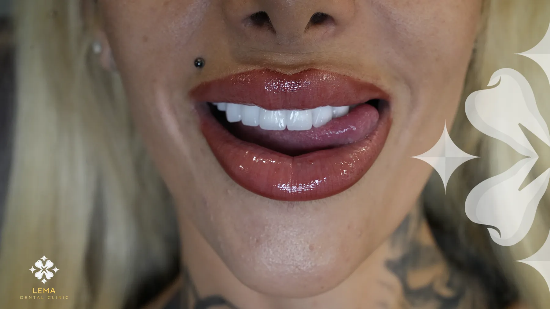 Ce Conduce La Recesiunea Gingiilor