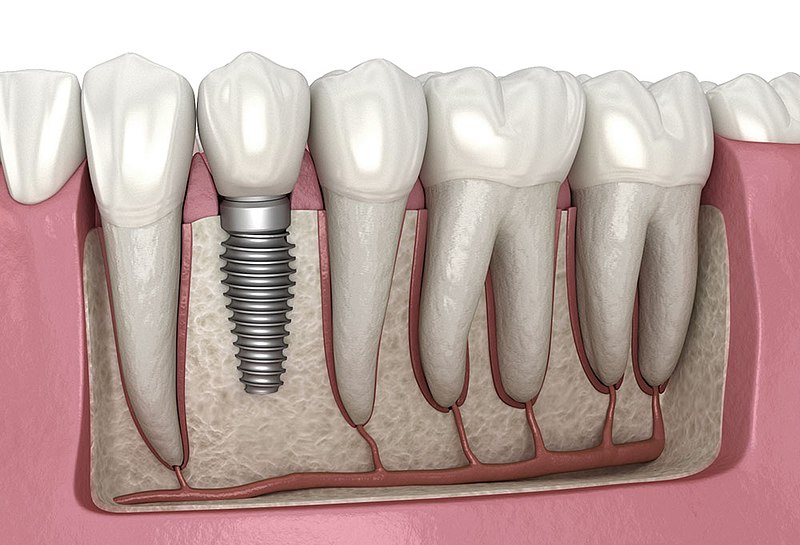 Best Destinations For Dental Implants