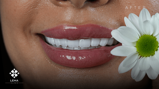Quanto Tempo Dureranno Le Mie Faccette Dentali