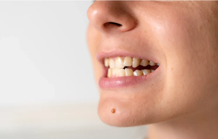 malocclusion dentaire
