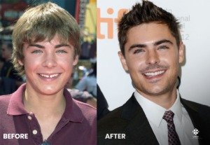 Zac Efron denti prima