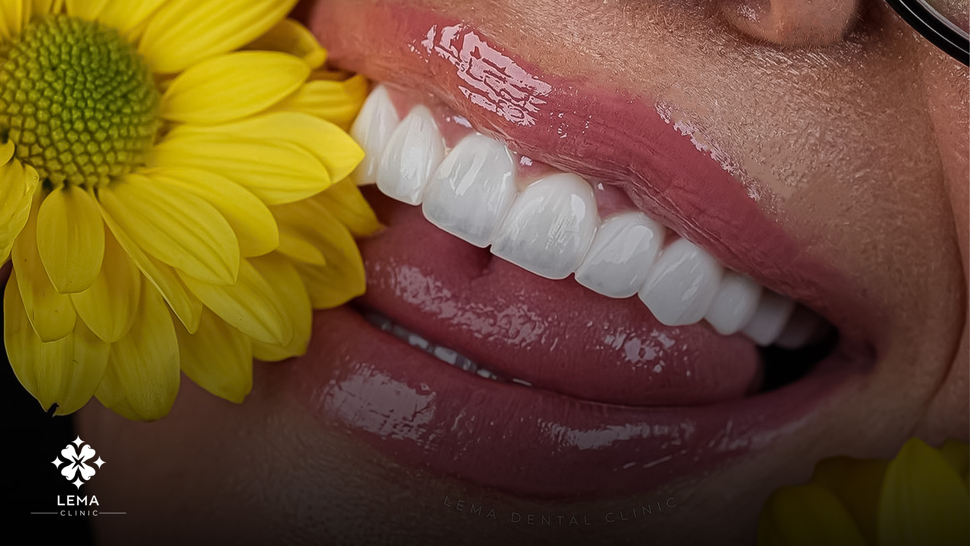 dental decay