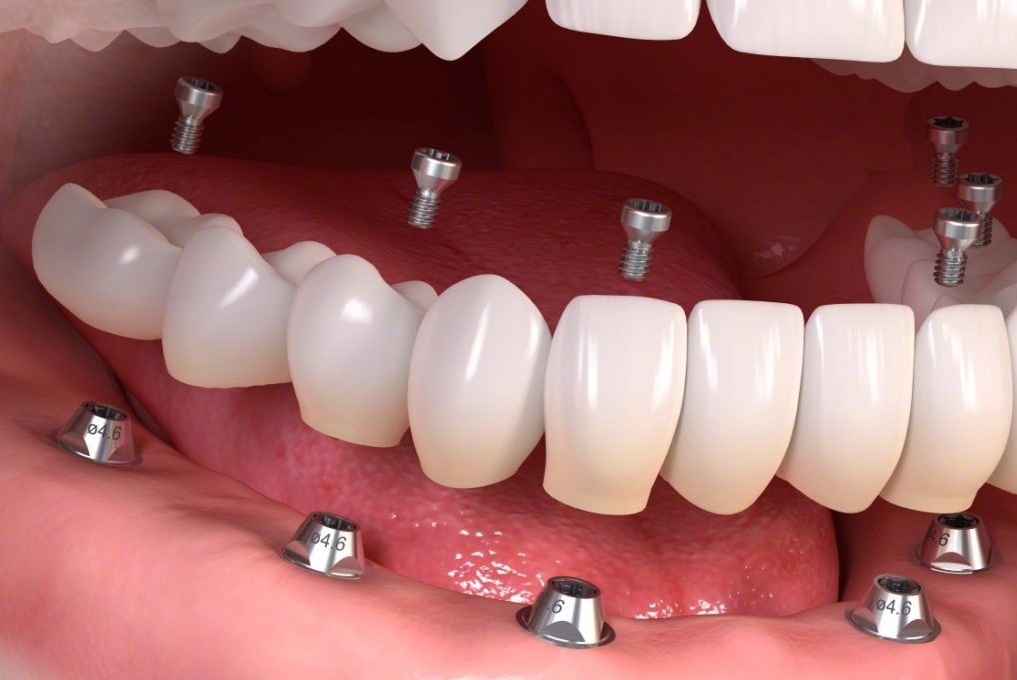 Comprehensive Guide To Whole Mouth Implants Cost