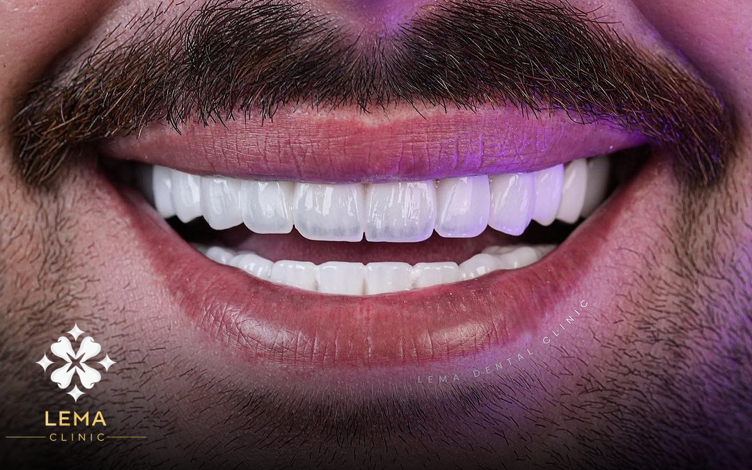 Zirconium crown