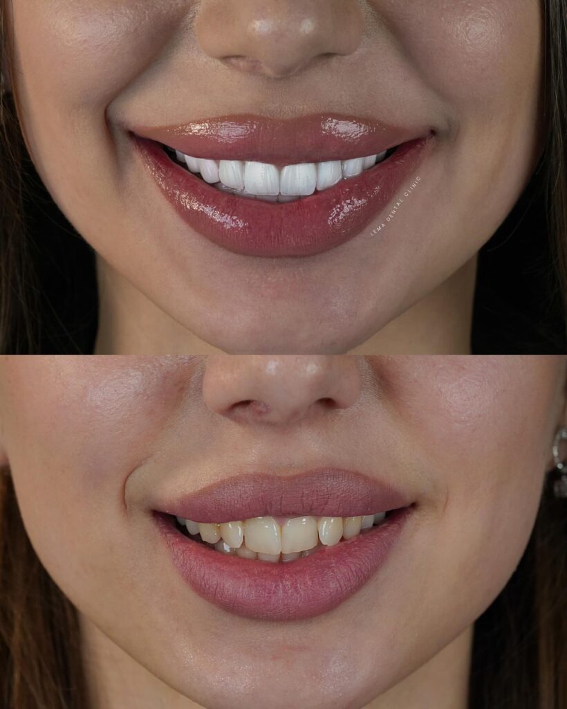 e-max veneers