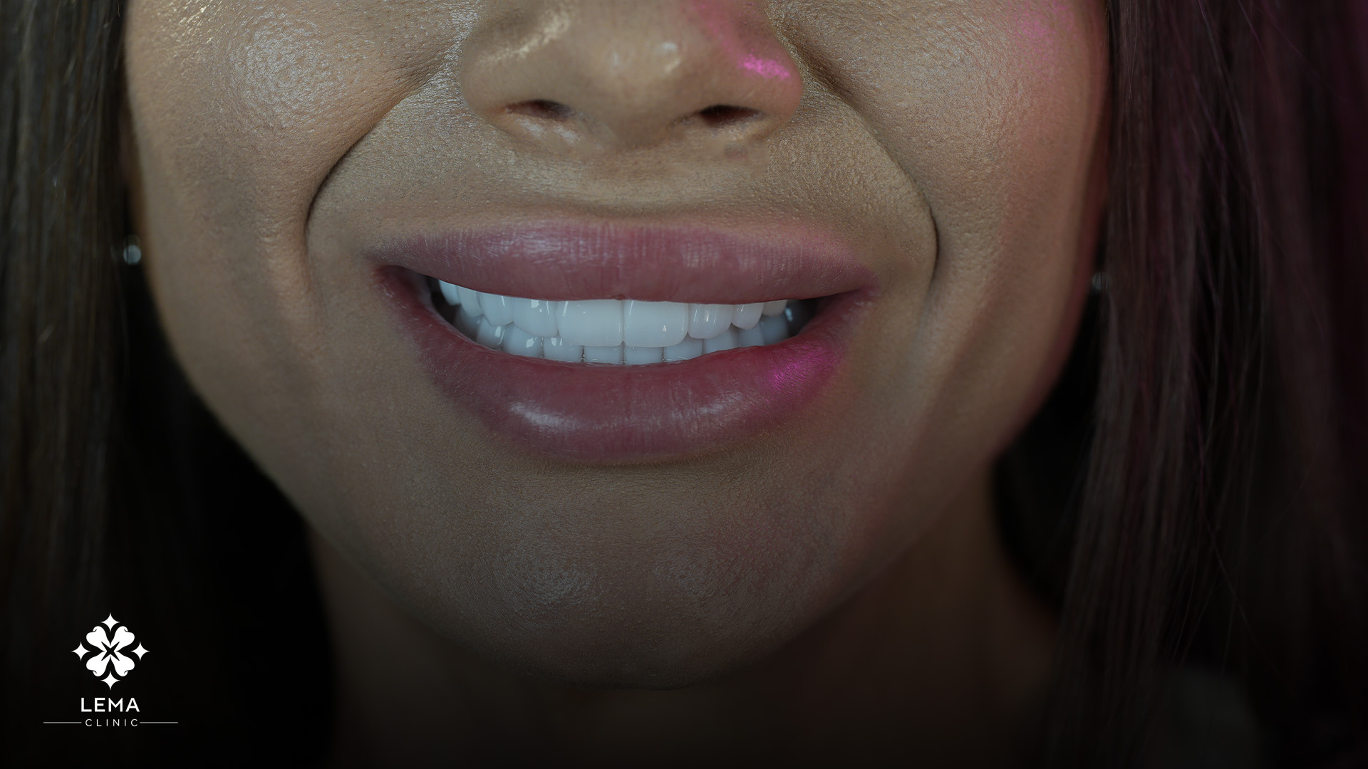 gummy smile ameliyatı neden yapılır