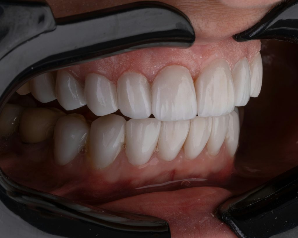 Hollywood Smile dental clinic Turkey