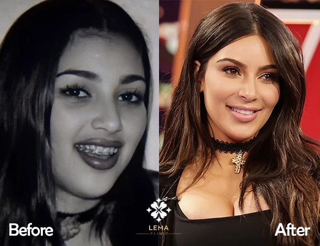 Kim Kardashian teeth before