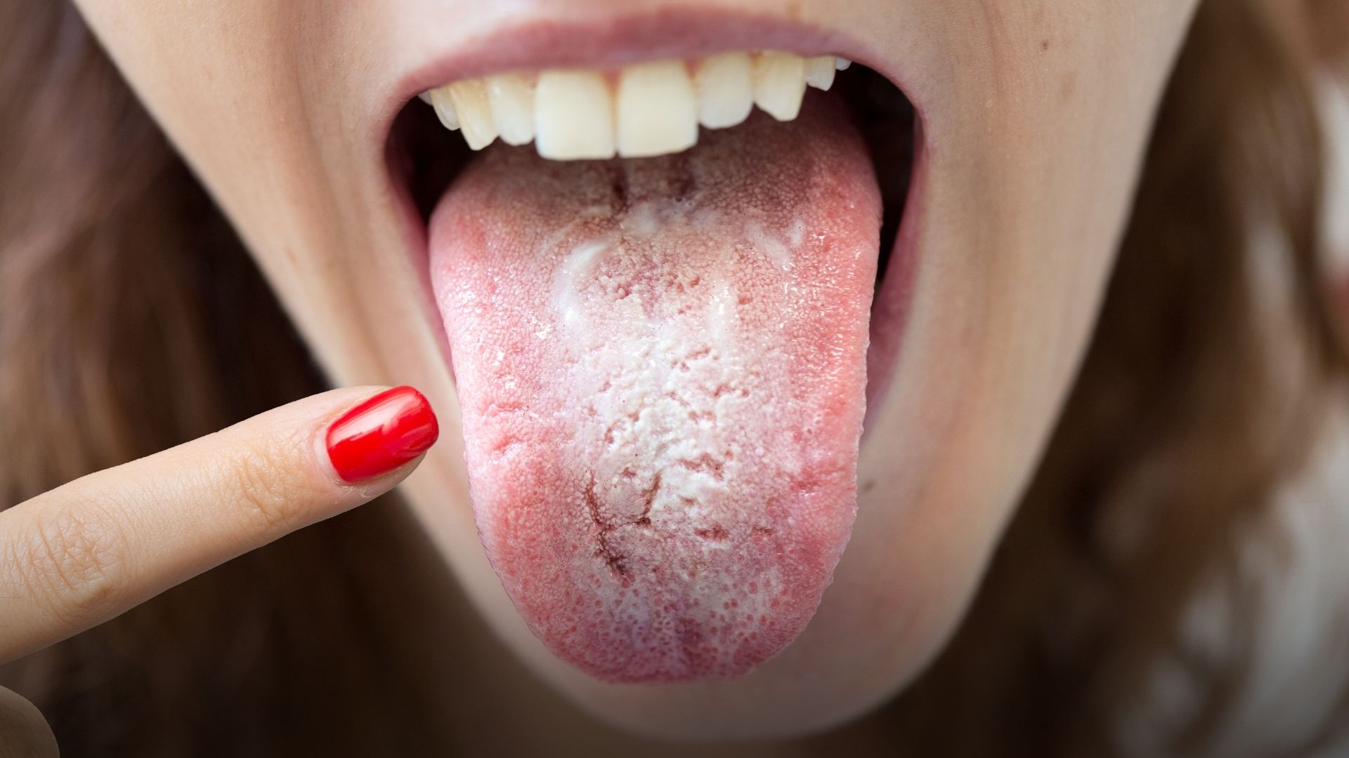 langues blanches causes