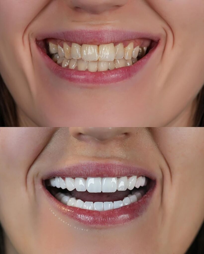 Veneers Before & After