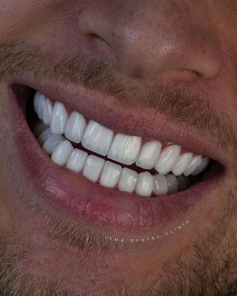 what are veneers