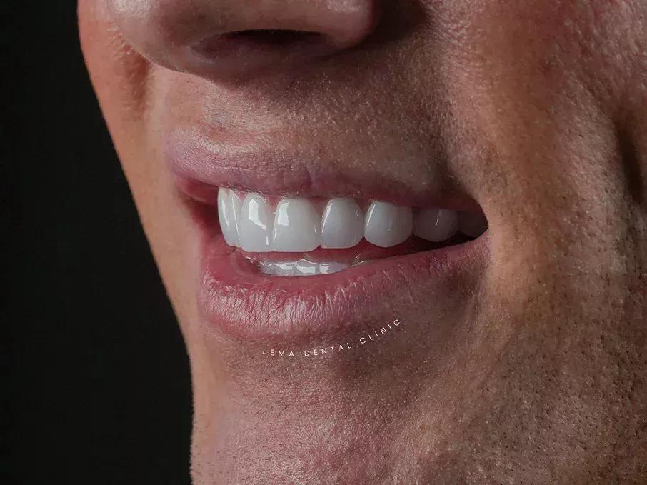 root canal costt root canal cost