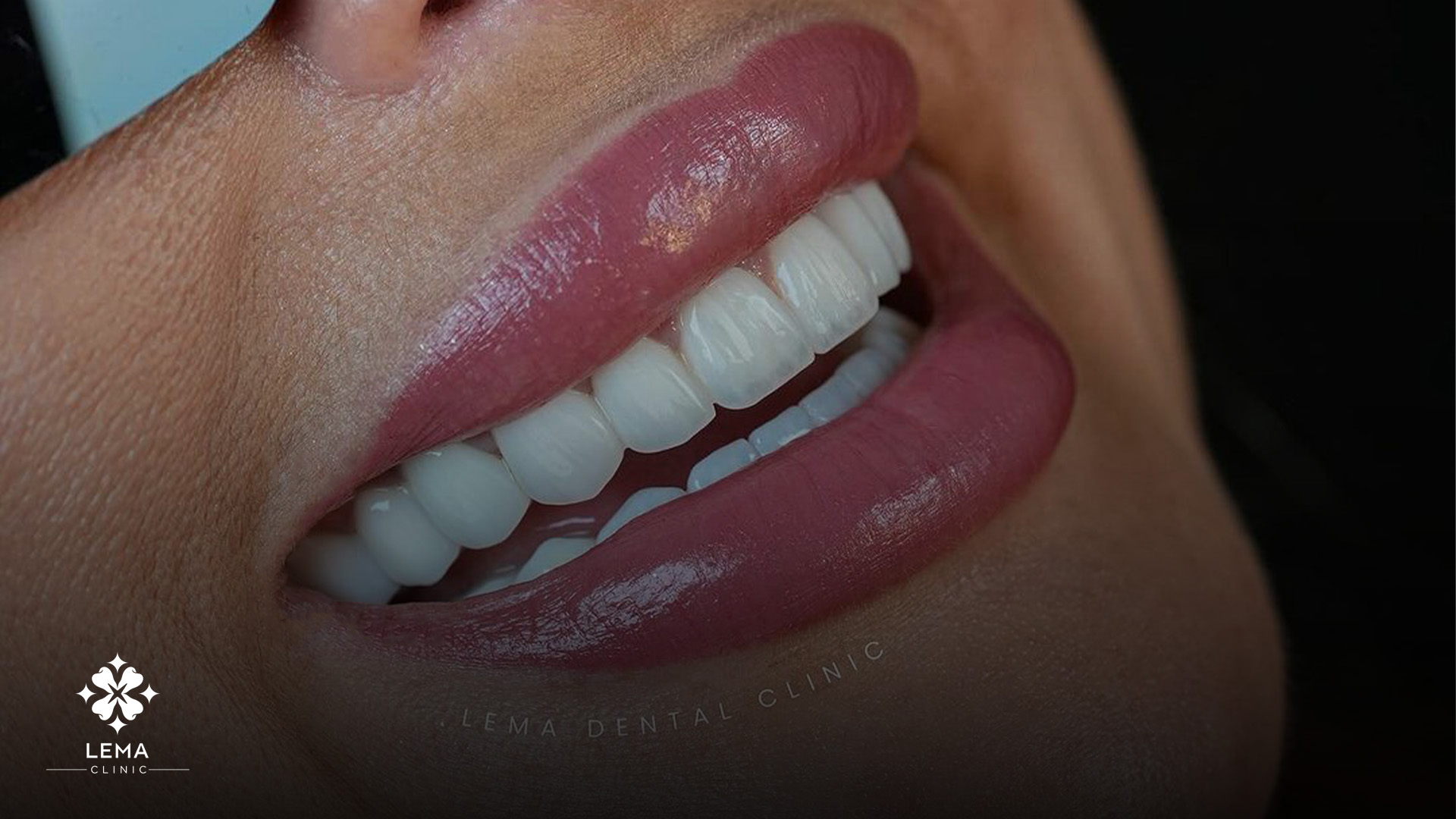 Композитно залепване в стоматологията